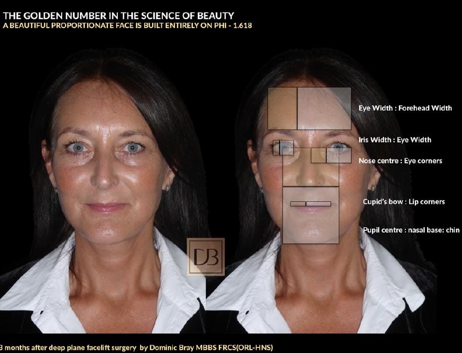 3 months after deep place facelift surgery