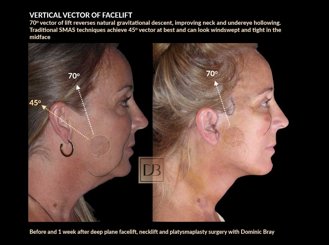 Vertical vector of facelift - before and 1 week after