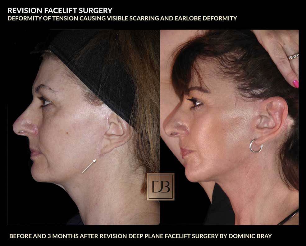 revision facelift