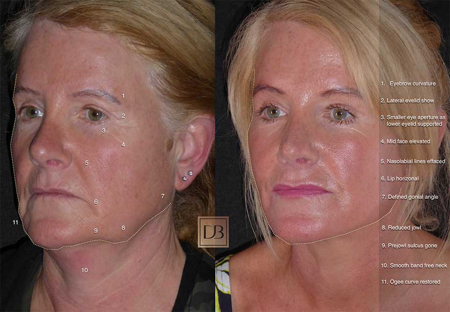 What makes a great facelift?